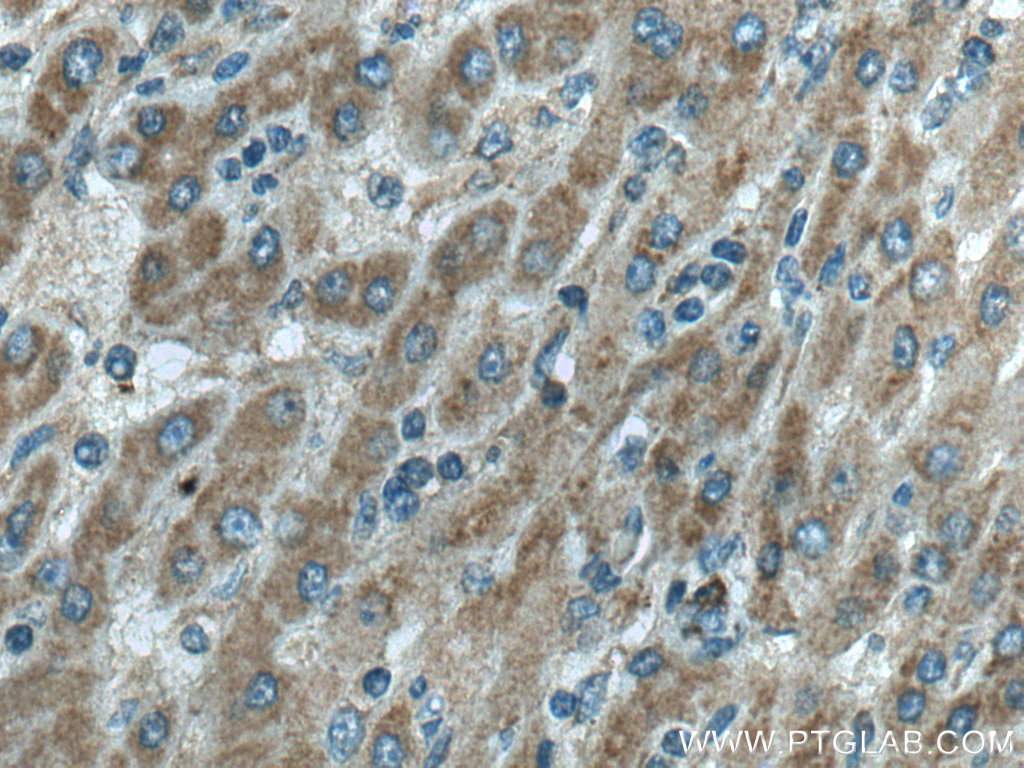 IHC staining of human liver cancer using 17854-1-AP