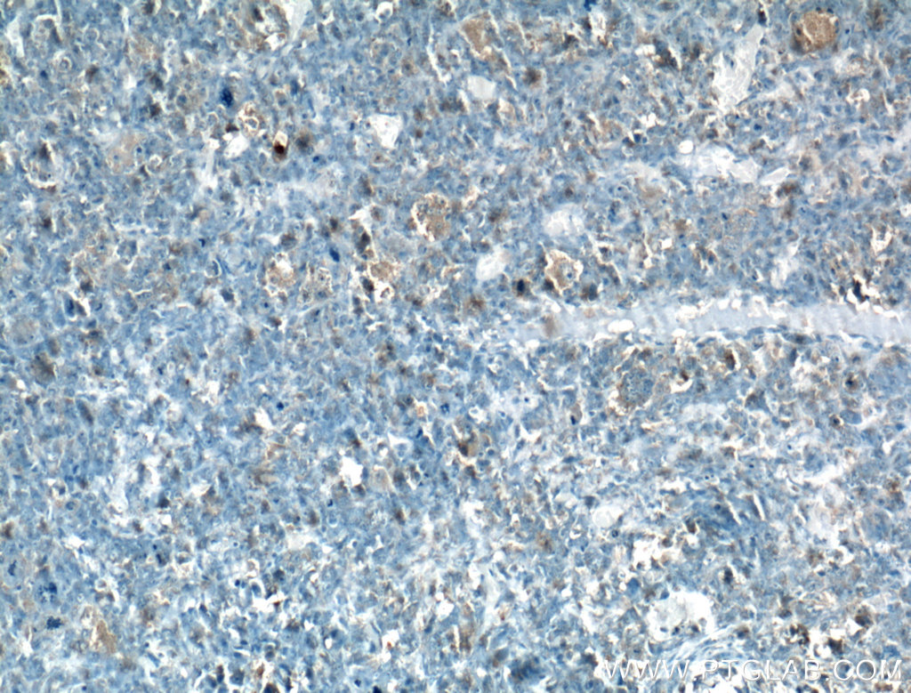 IHC staining of human osteosarcoma using 13542-1-AP