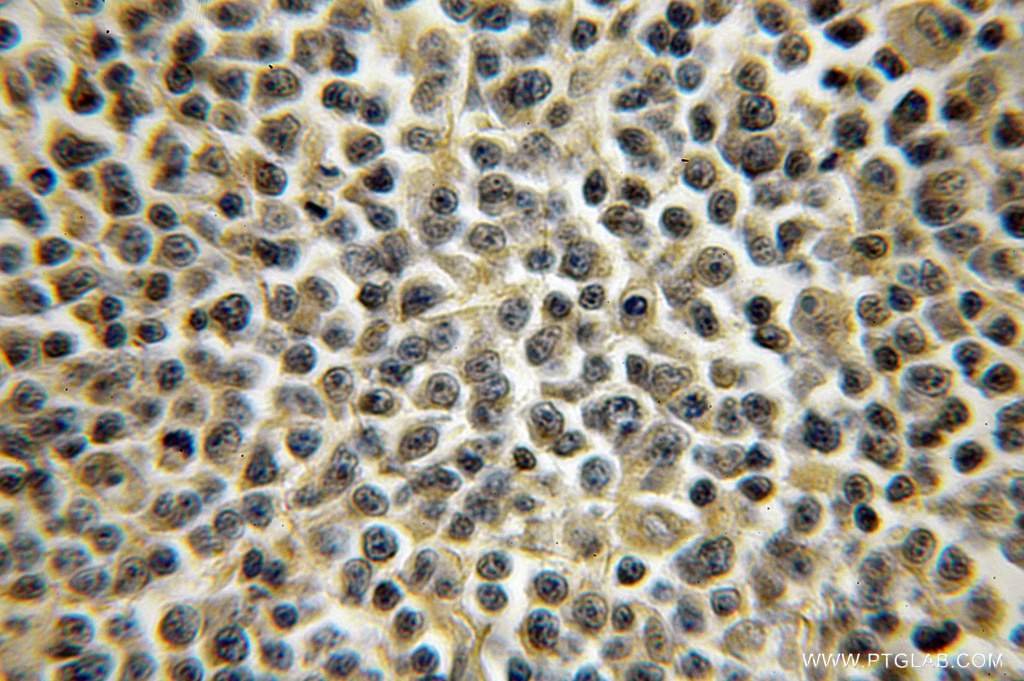 IHC staining of human lymphoma using 12396-1-AP