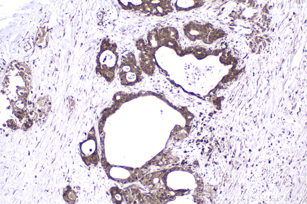 IHC staining of human pancreas cancer using 10678-1-AP IHC staining of human pancreas cancer using 10678-1-AP