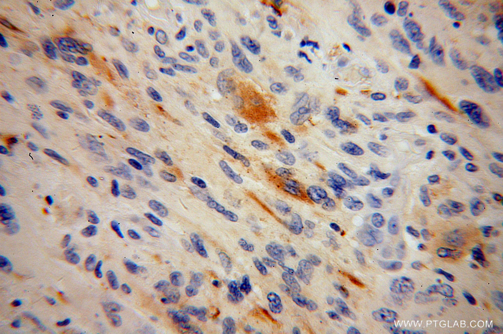 IHC staining of human gliomas using 14056-1-AP