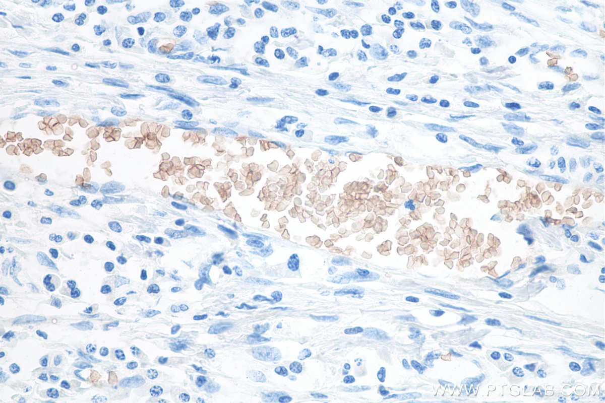IHC staining of human colon cancer using 67714-1-Ig IHC staining of human colon cancer using 67714-1-Ig