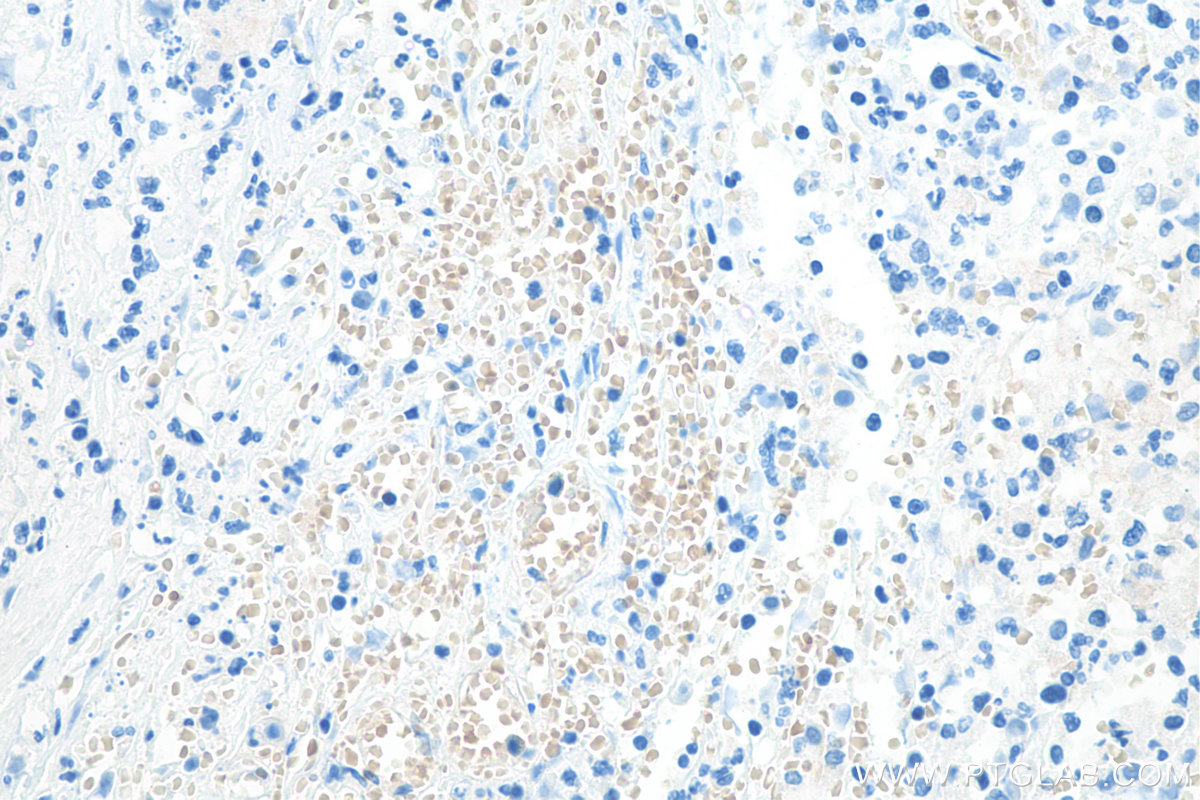 IHC staining of human stomach cancer using 67714-1-Ig IHC staining of human stomach cancer using 67714-1-Ig
