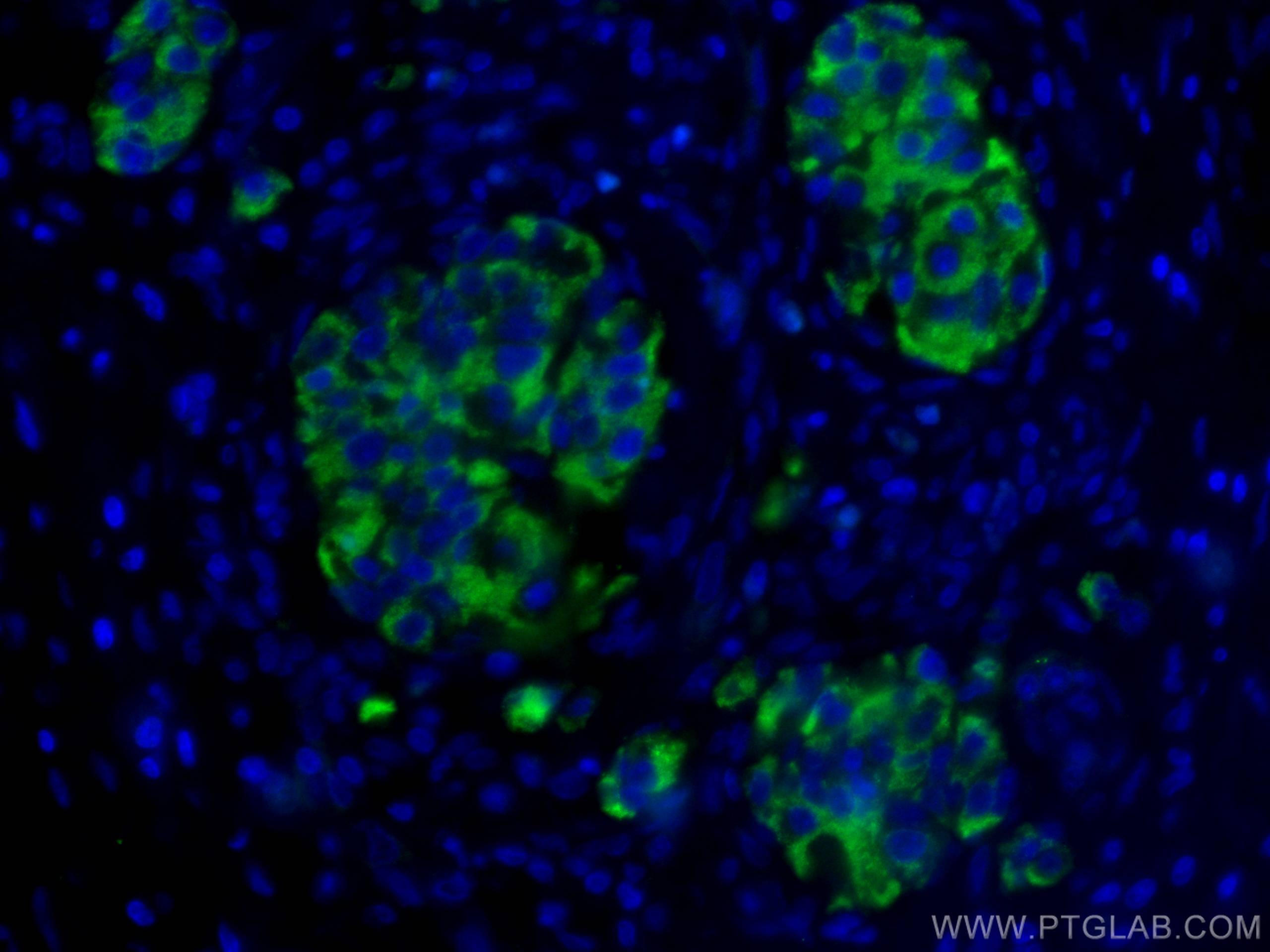 IF Staining of human pancreas cancer using 15924-1-AP