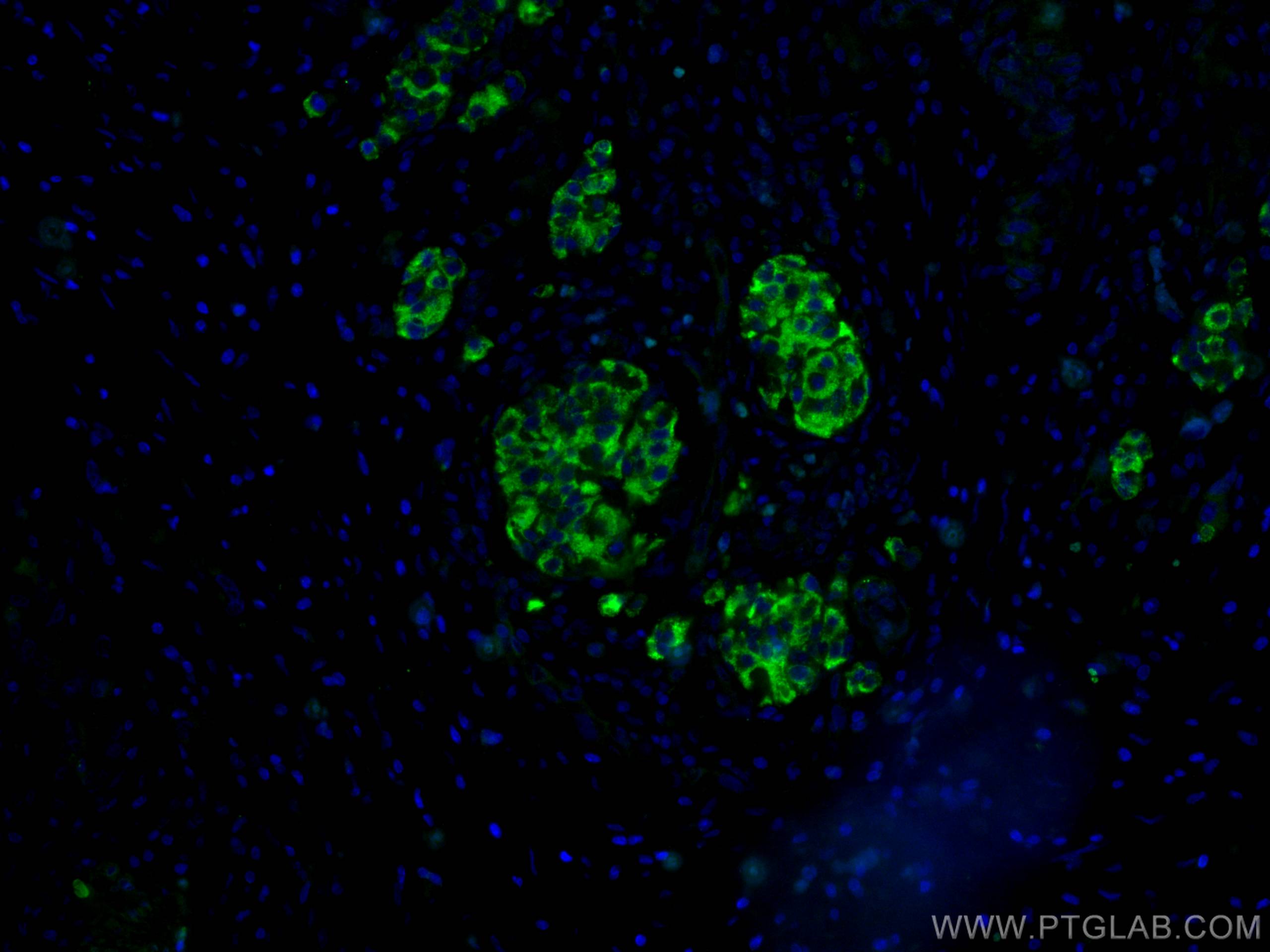 IF Staining of human pancreas cancer using 15924-1-AP