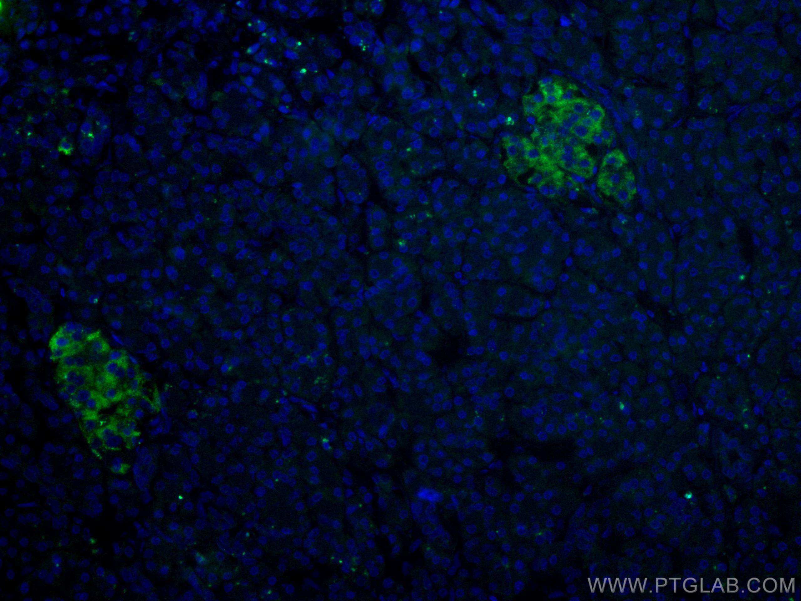 IF Staining of human pancreas cancer using 66714-1-Ig (same clone as 66714-1-PBS)