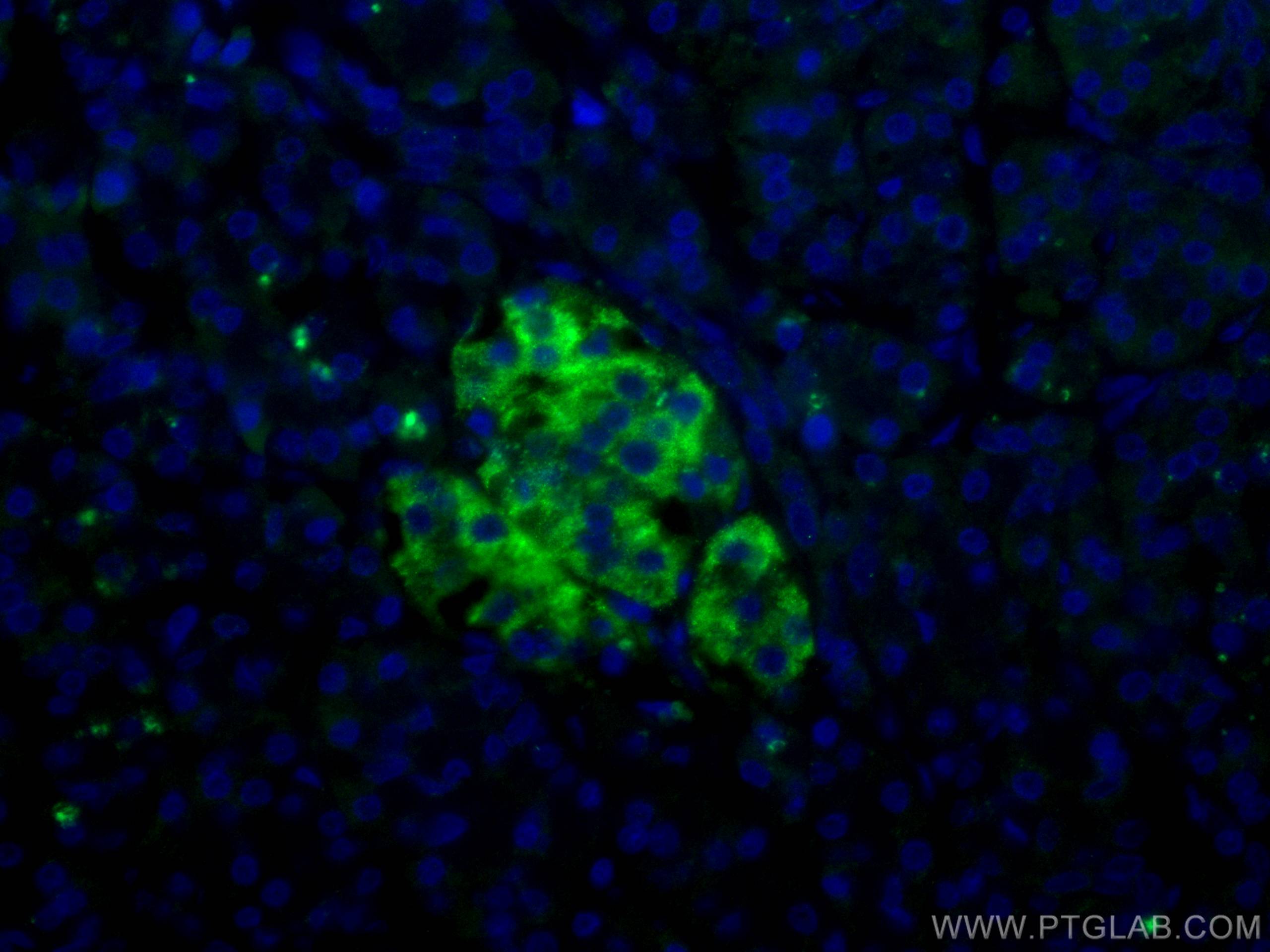 IF Staining of human pancreas cancer using 66714-1-Ig (same clone as 66714-1-PBS)