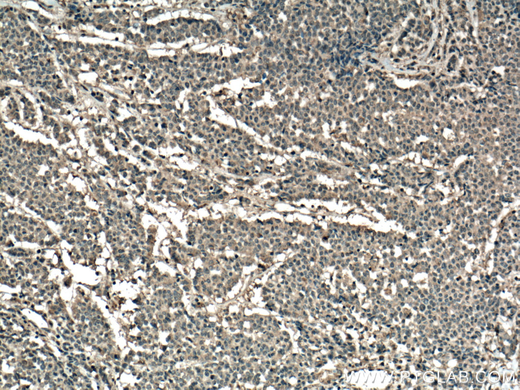 IHC staining of human colon cancer using 66733-1-Ig (same clone as 66733-1-PBS)