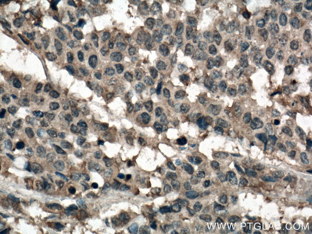 IHC staining of human colon cancer using 66733-1-Ig