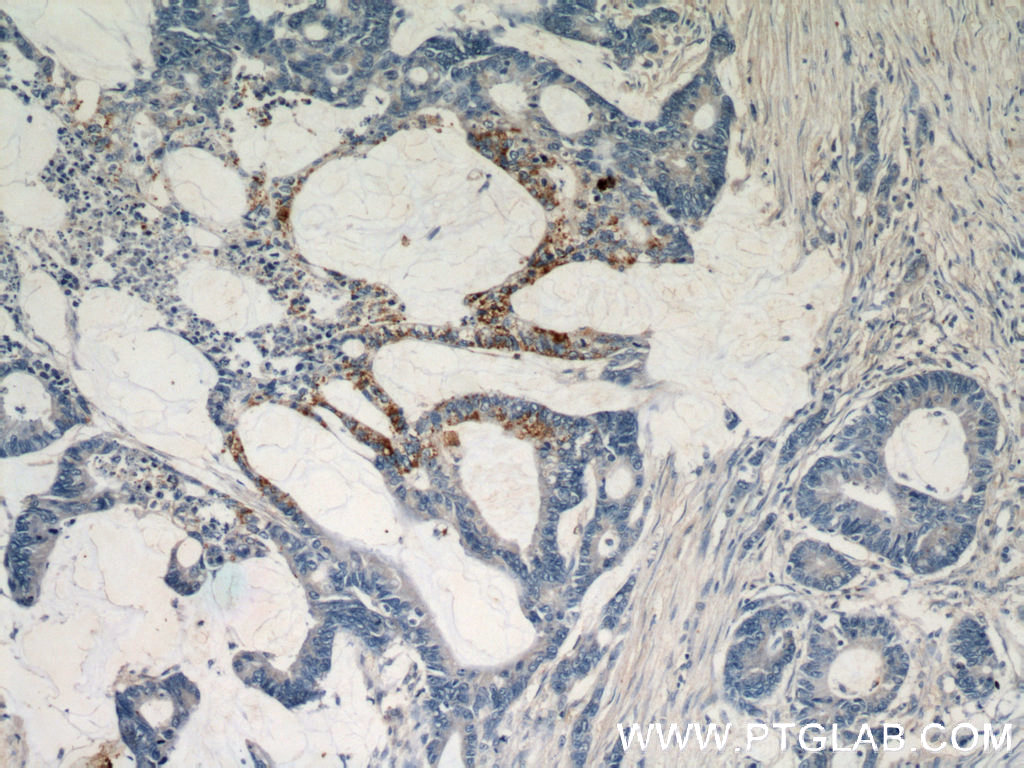 IHC staining of human colon cancer using 12290-1-AP