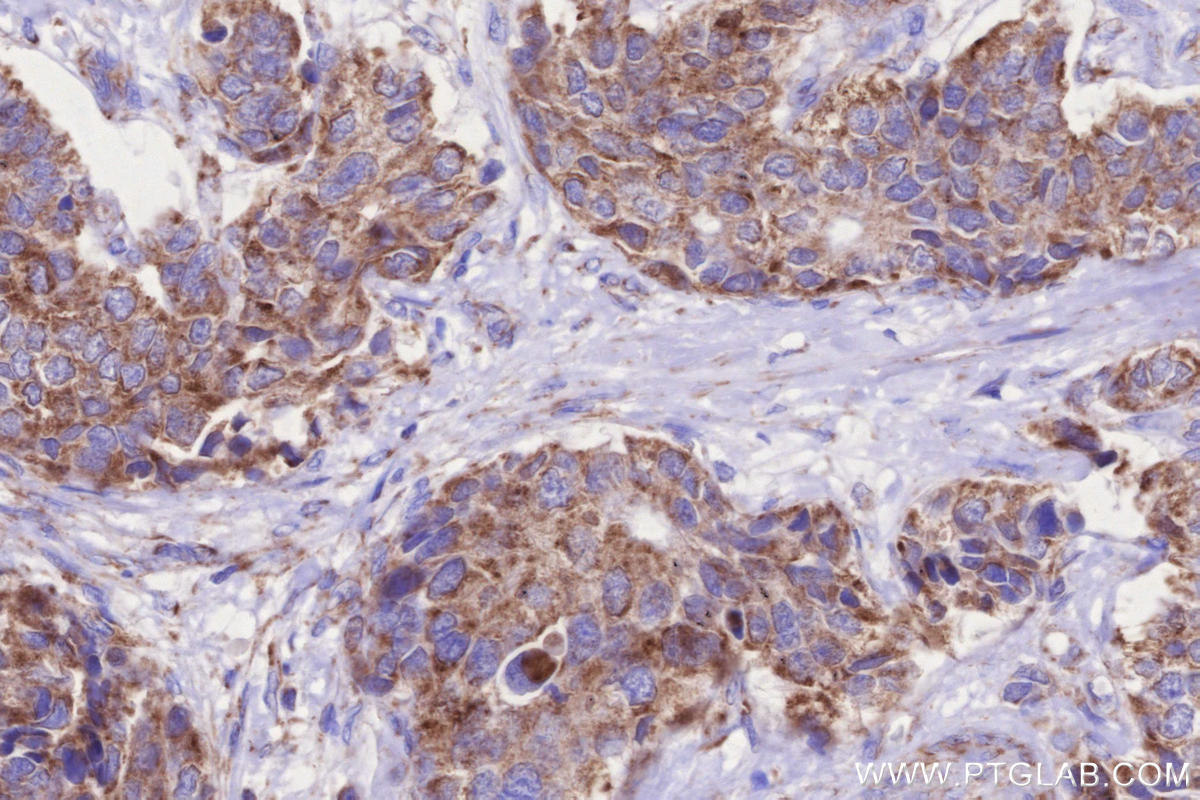 IHC staining of human stomach cancer using 84055-5-RR