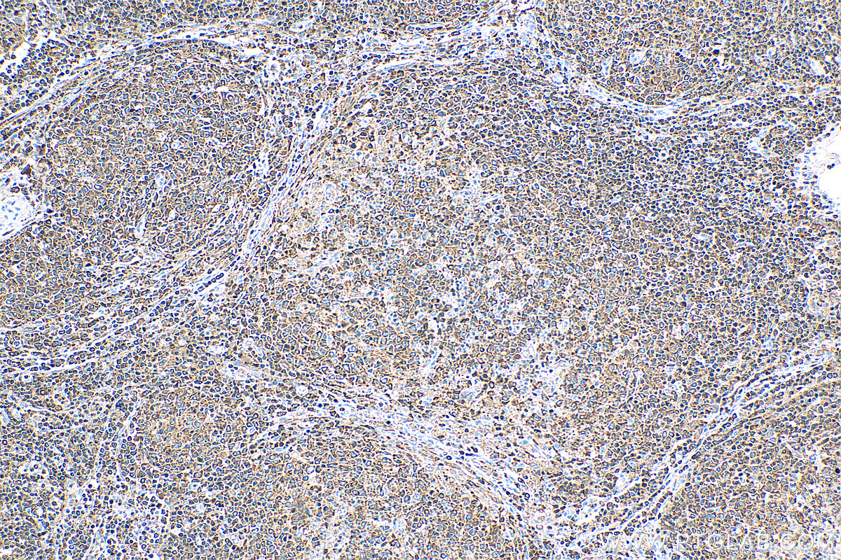 IHC staining of human lymphoma using 13500-1-AP