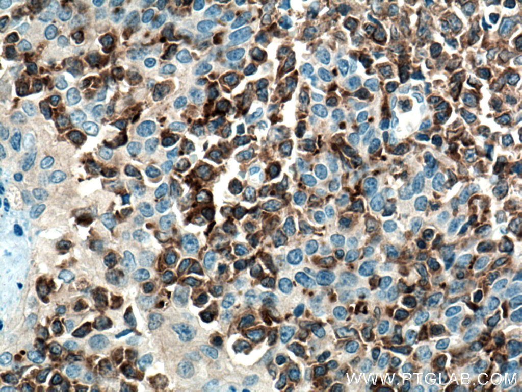 IHC staining of human tonsillitis using 67143-1-Ig (same clone as 67143-1-PBS)