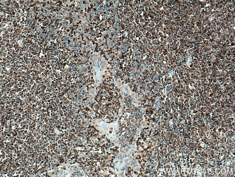 IHC staining of human tonsillitis using 67143-1-Ig (same clone as 67143-1-PBS)