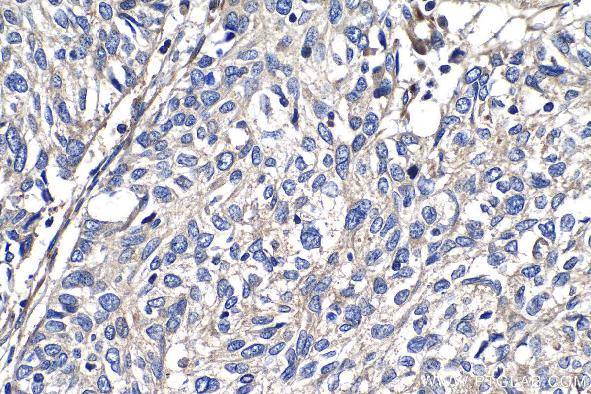 IHC staining of human cervical cancer using 15272-1-AP