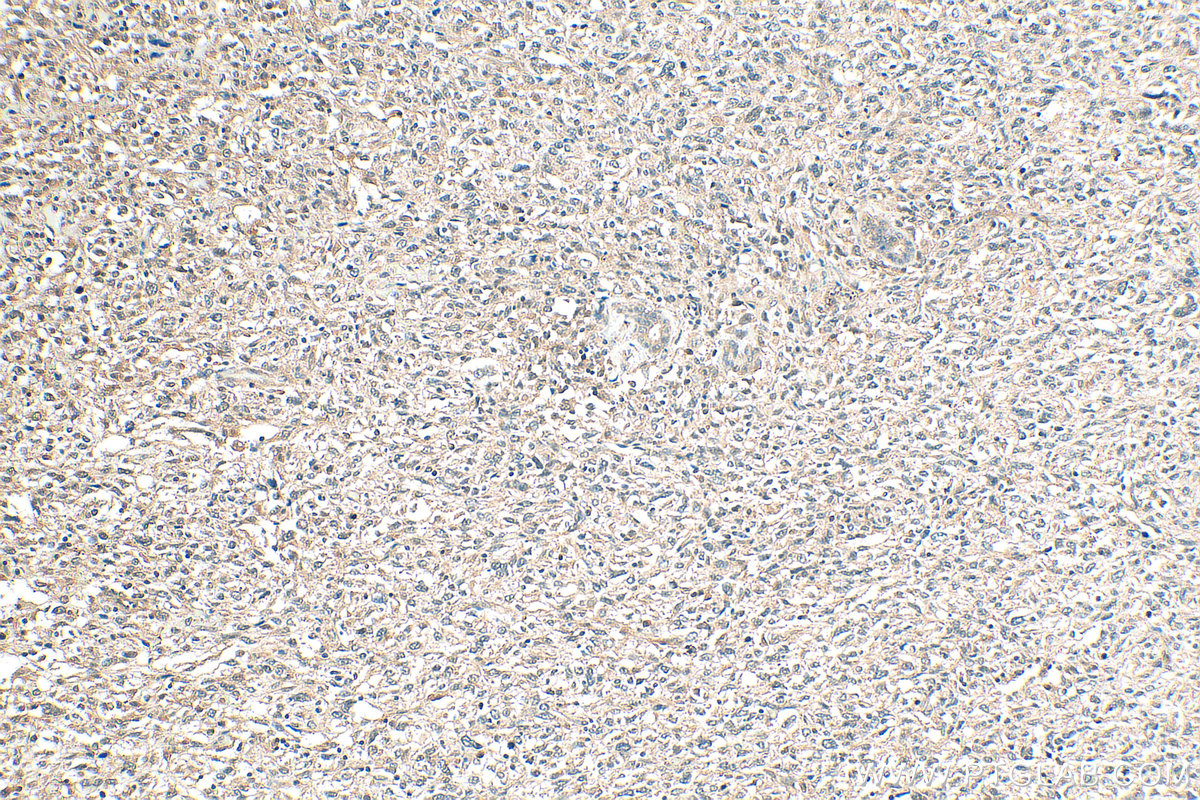 IHC staining of human pancreas cancer using 11138-1-AP IHC staining of human pancreas cancer using 11138-1-AP