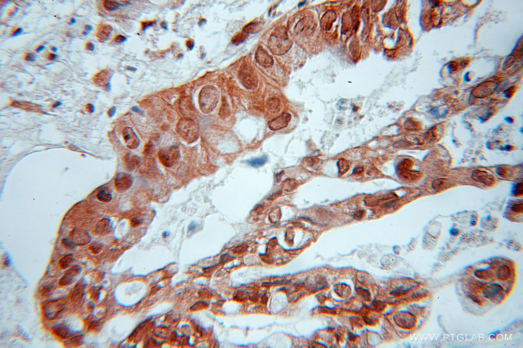 Immunohistochemical analysis of  paraffin-embedded human pancreas cancer using 11138-1-AP (RIC8A antibody) at dilution of 1:50 (under 10x lens). IHC staining of human pancreas cancer using 11138-1-AP
