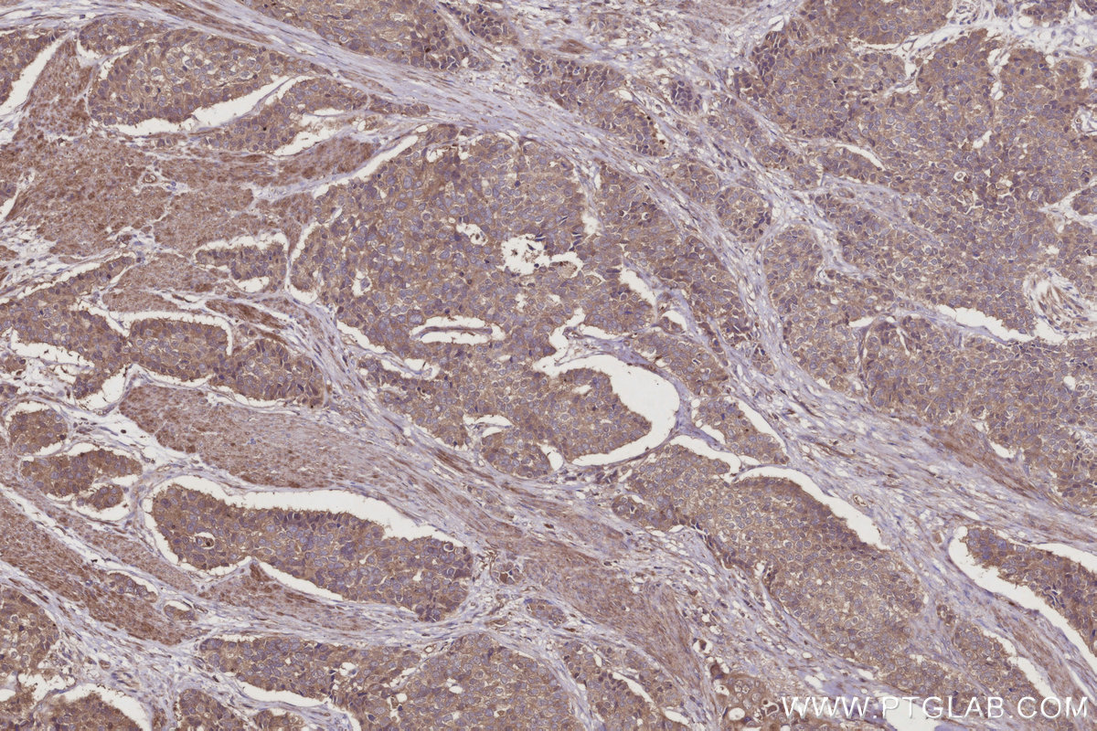 IHC staining of human stomach cancer using 66625-1-Ig IHC staining of human stomach cancer using 66625-1-Ig