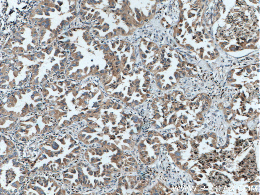IHC staining of human lung cancer using 27248-1-AP