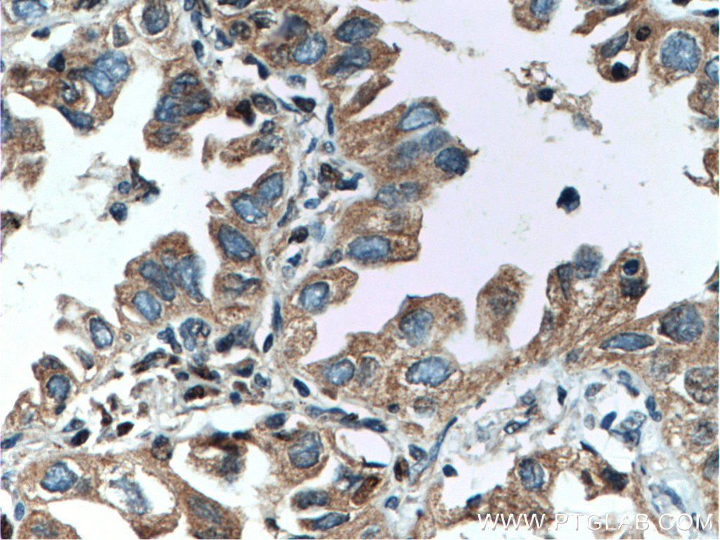 IHC staining of human lung cancer using 27248-1-AP