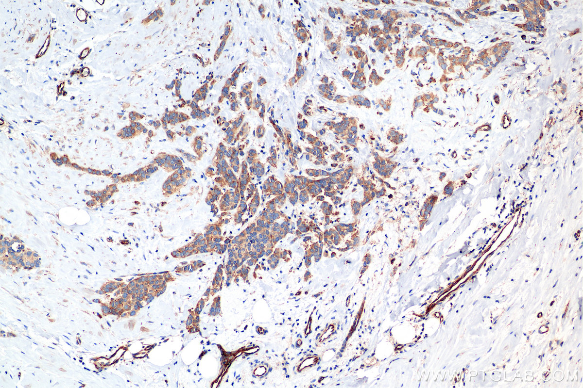 IHC staining of human breast cancer using 85449-5-RR