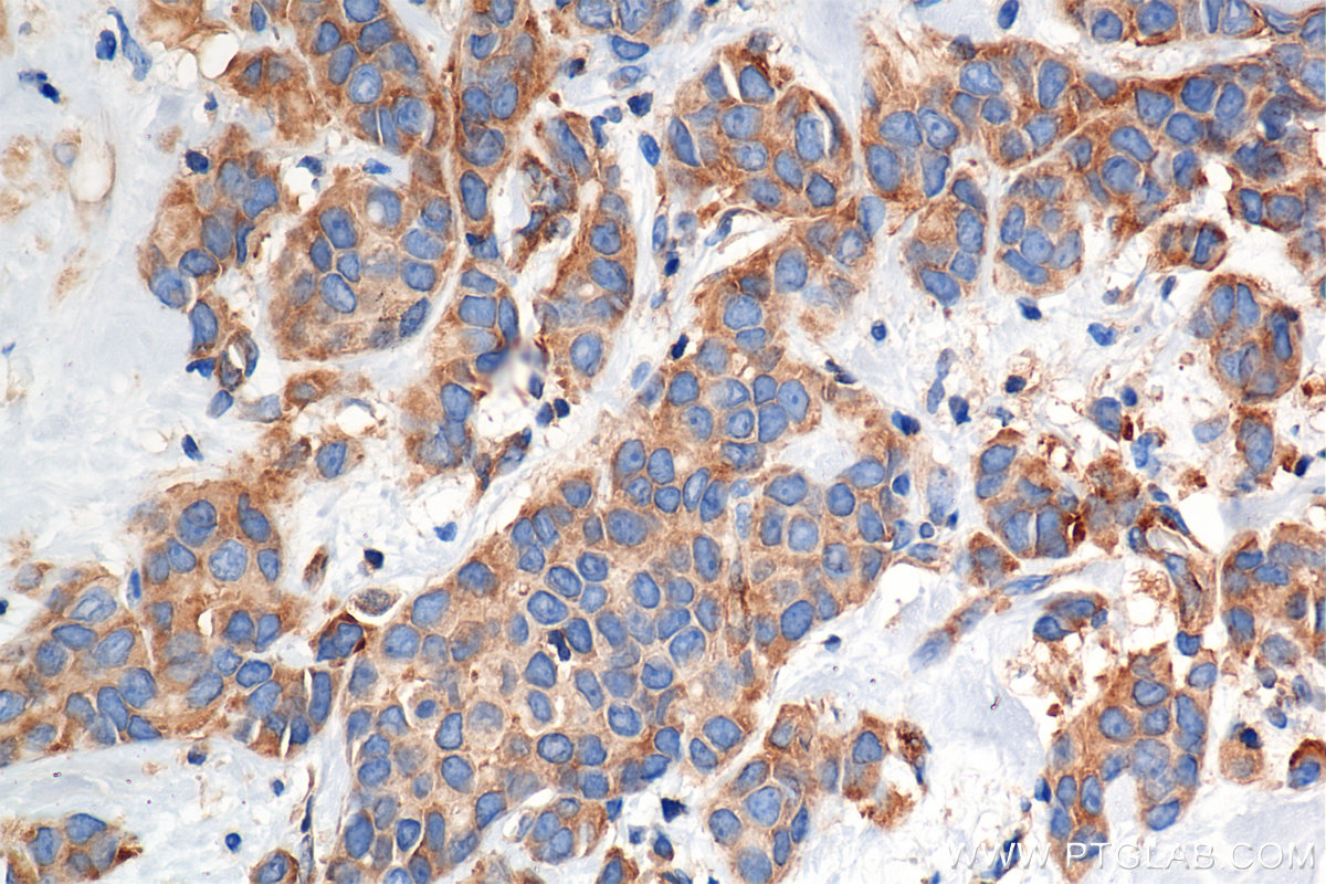 IHC staining of human breast cancer using 85449-5-RR