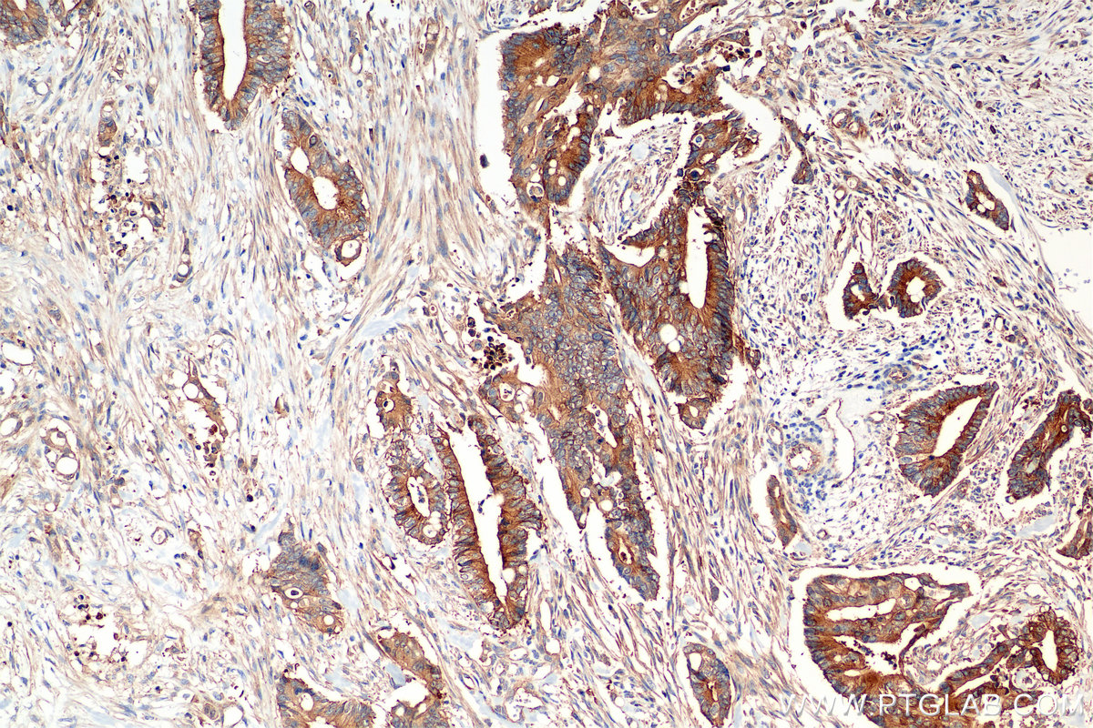 IHC staining of human rectal cancer using 85449-5-RR