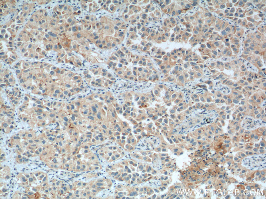 IHC staining of human lung cancer using 55338-1-AP