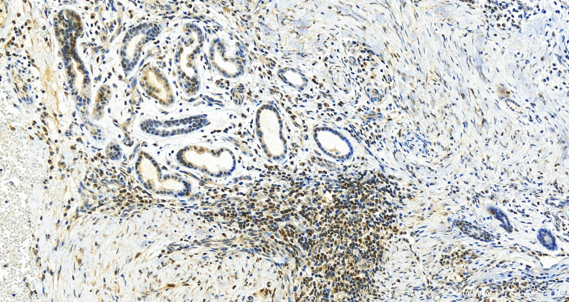 IHC staining of human skin cancer using 67976-1-Ig