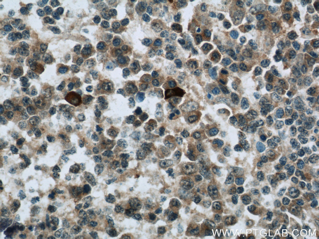 IHC staining of human tonsillitis using 22577-1-AP