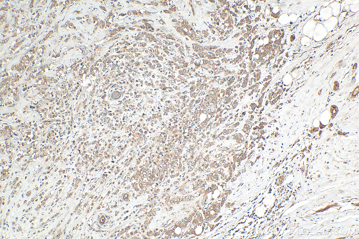 IHC staining of human breast cancer using 16948-1-AP