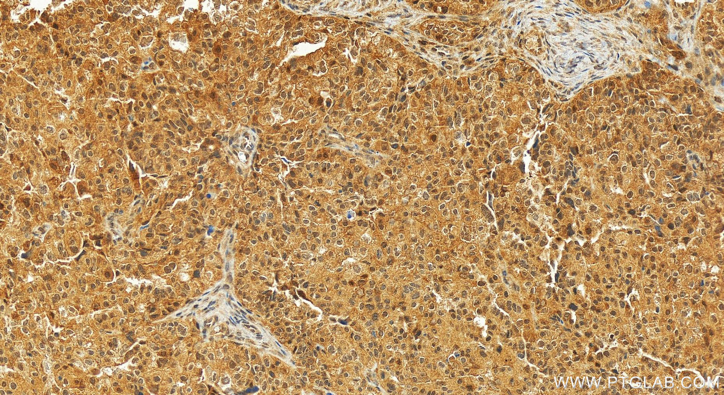 IHC staining of human ovary cancer using 14338-1-AP