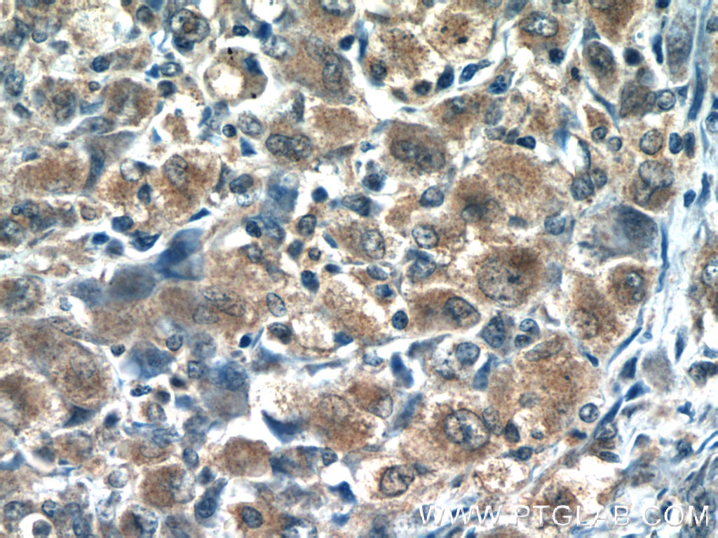 IHC staining of human lymphoma using 13290-1-AP