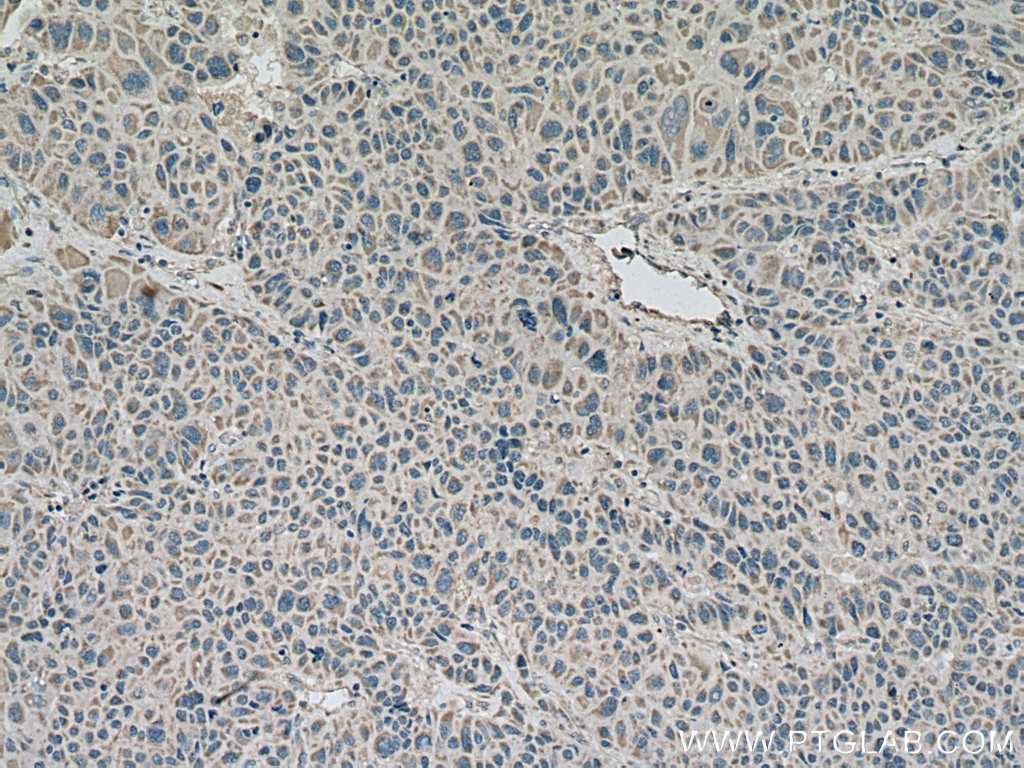IHC staining of human liver cancer using 26015-1-AP