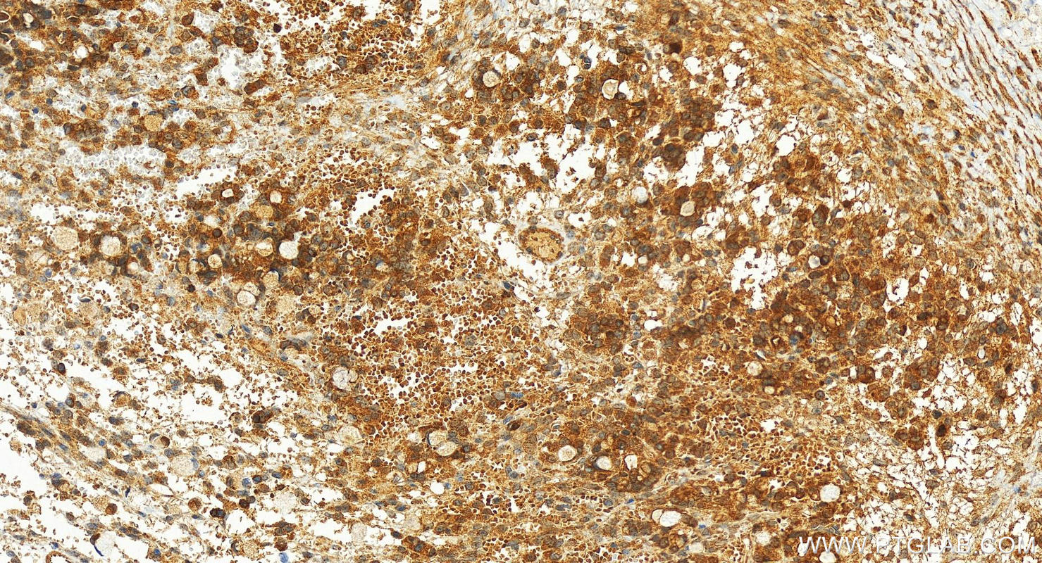 IHC staining of human ovary cancer using 23927-1-AP