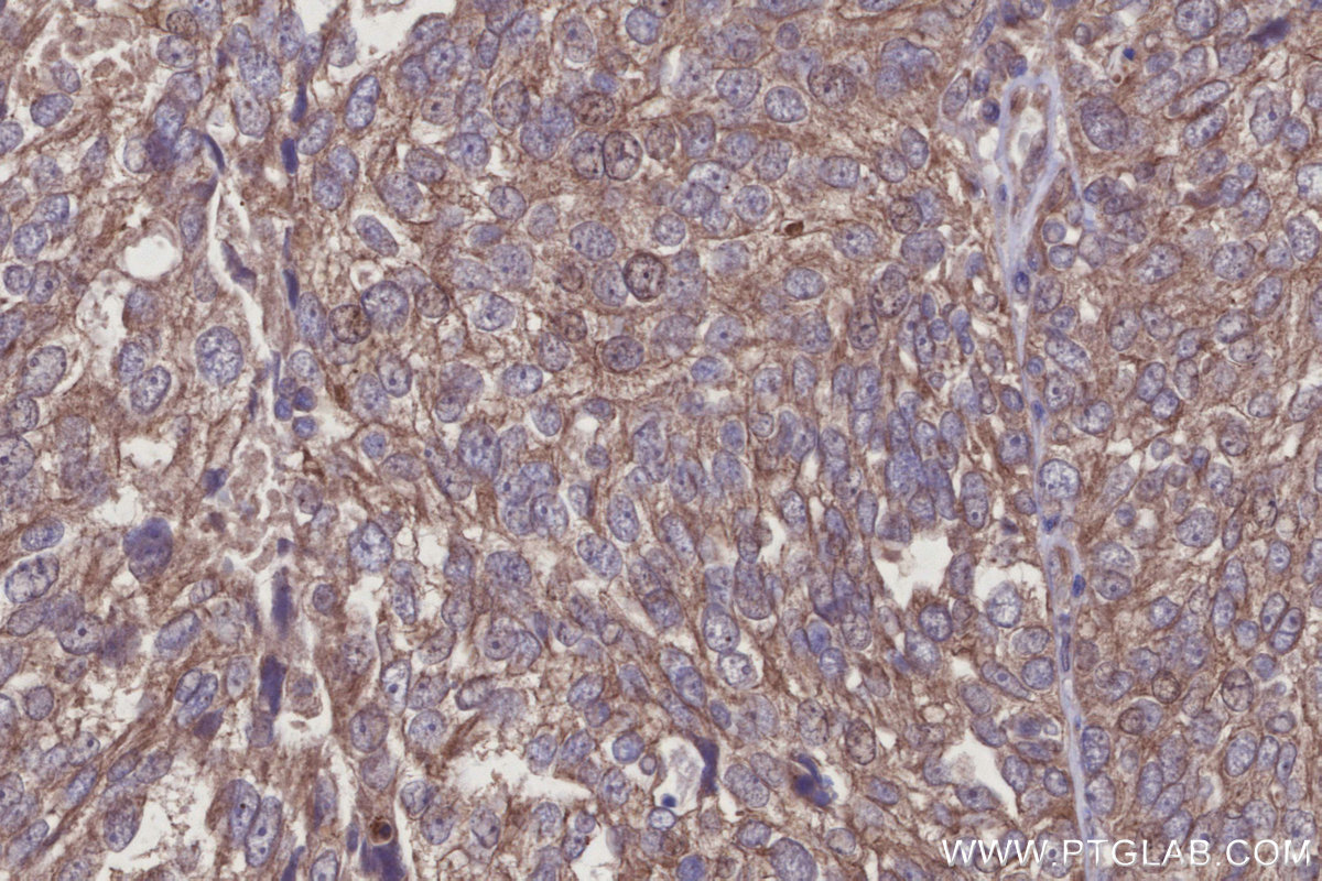 IHC staining of human ovary cancer using 24618-1-AP