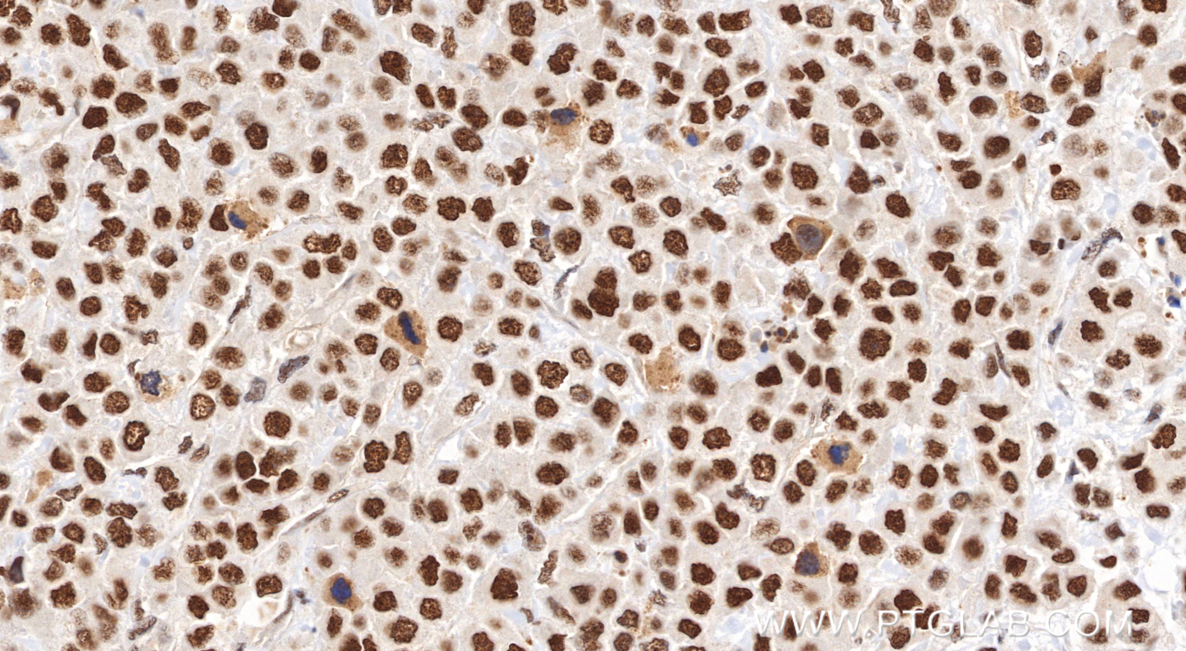 Immunohistochemical analysis of paraffin-embedded human breast cancer tissue slide using 85630-6-RR (RNF20 antibody) at dilution of 1:2000 (under 40x lens). Heat mediated antigen retrieval with Tris-EDTA buffer (pH 9.0). IHC staining of human breast cancer using 85630-6-RR