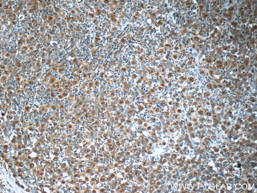 IHC staining of human lymphoma using 21028-1-AP