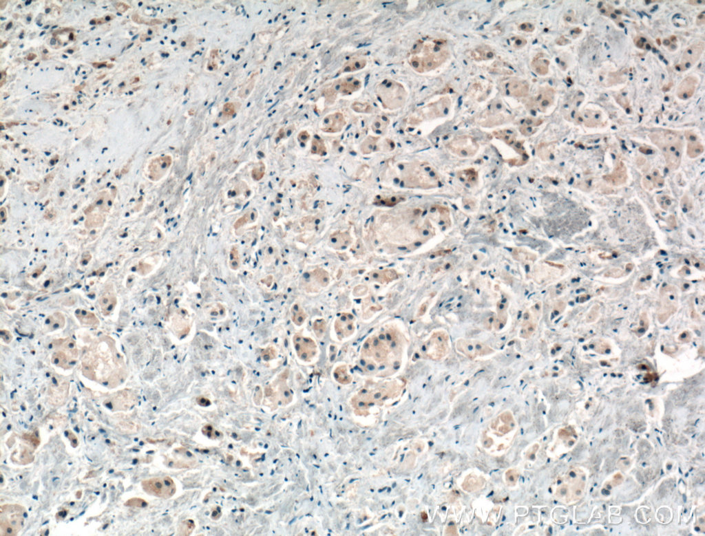 IHC staining of human breast cancer using 16289-1-AP