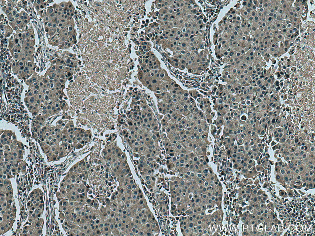IHC staining of human breast cancer using 10629-1-AP