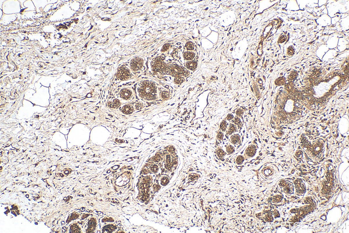 IHC staining of human breast cancer using 10629-1-AP