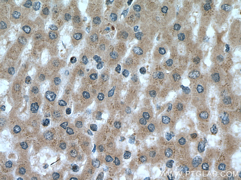 IHC staining of human liver cancer using 17233-1-AP