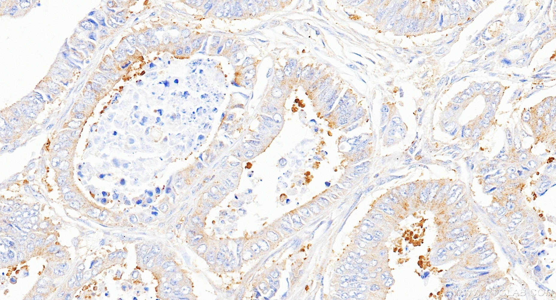 IHC staining of human colon cancer using 86740-1-RR IHC staining of human colon cancer using 86740-1-RR