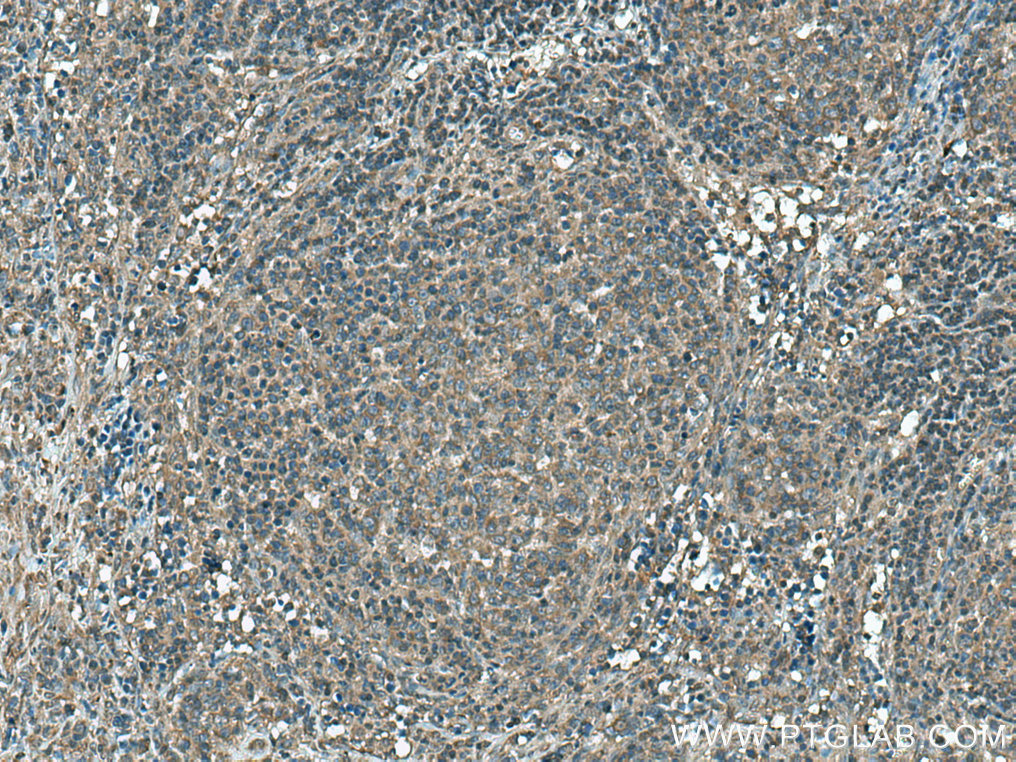 IHC staining of human lymphoma using 21850-1-AP