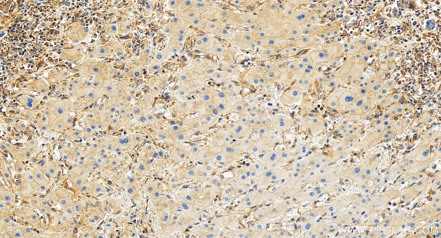 IHC staining of human intrahepatic cholangiocarcinoma using 83166-5-RR (same clone as 83166-5-PBS)
