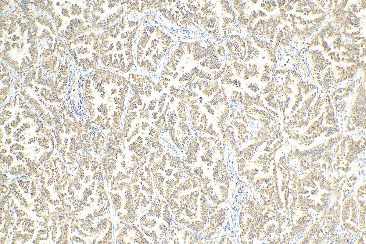 IHC staining of human lung cancer using 20247-1-AP