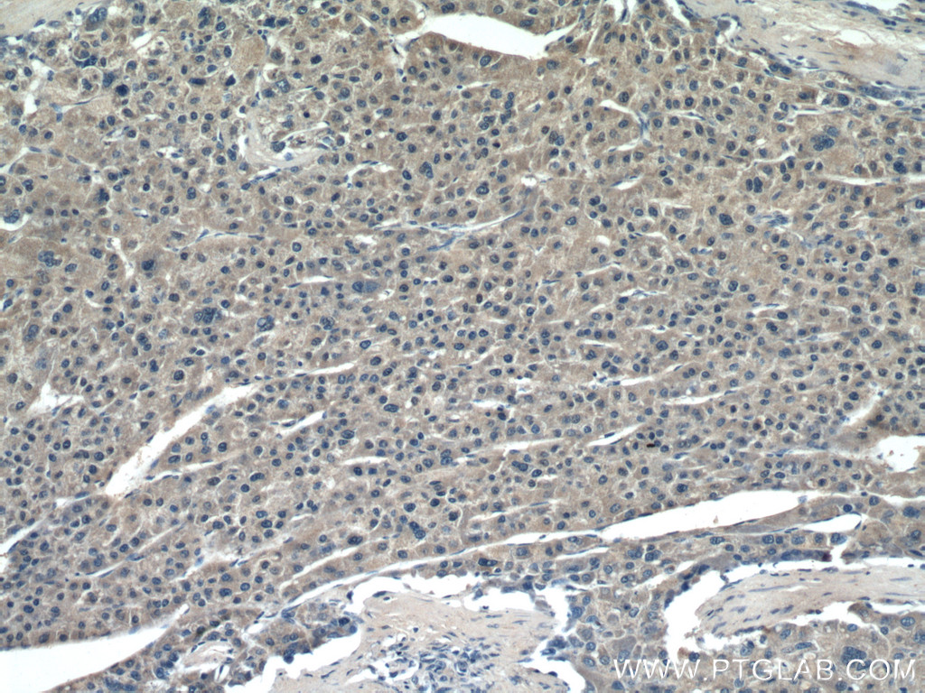 IHC staining of human liver cancer using 66633-1-Ig