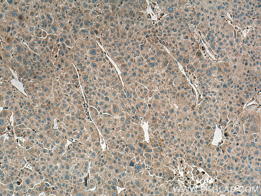 IHC staining of human liver cancer using 20248-1-AP