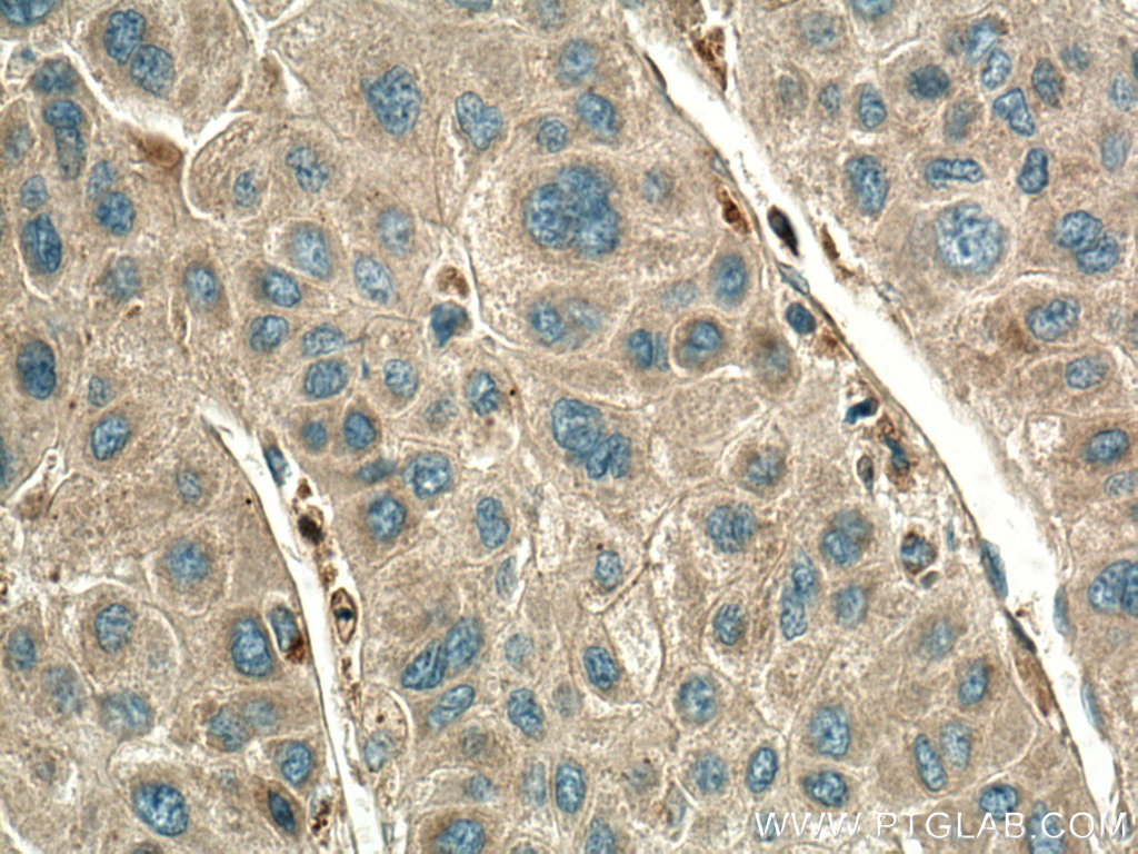 IHC staining of human liver cancer using 20248-1-AP