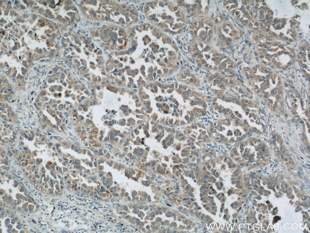 IHC staining of human lung cancer using 24200-1-AP